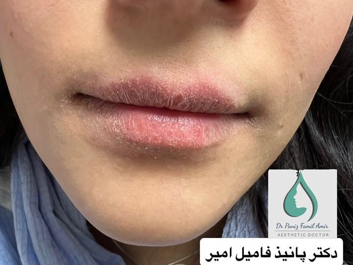 عوارض ژل